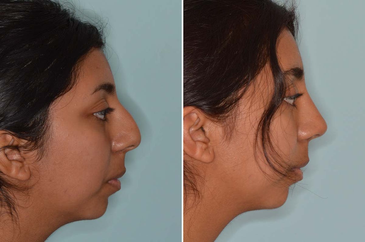 Ethnic Rhinoplasty before and after, lateral right.