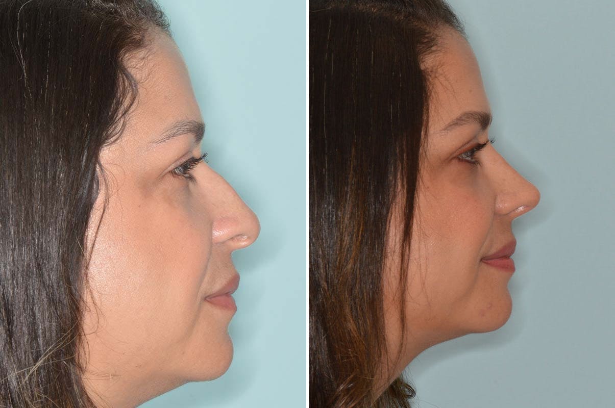 Ethnic Rhinoplasty before and after, lateral right.