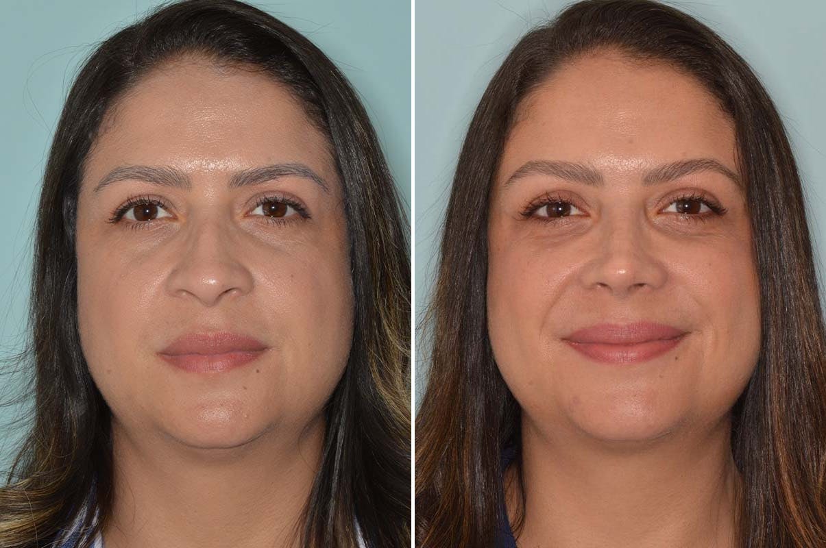 Ethnic Rhinoplasty before and after, frontal.