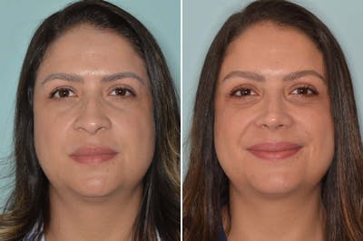 Ethnic Rhinoplasty before and after, frontal.