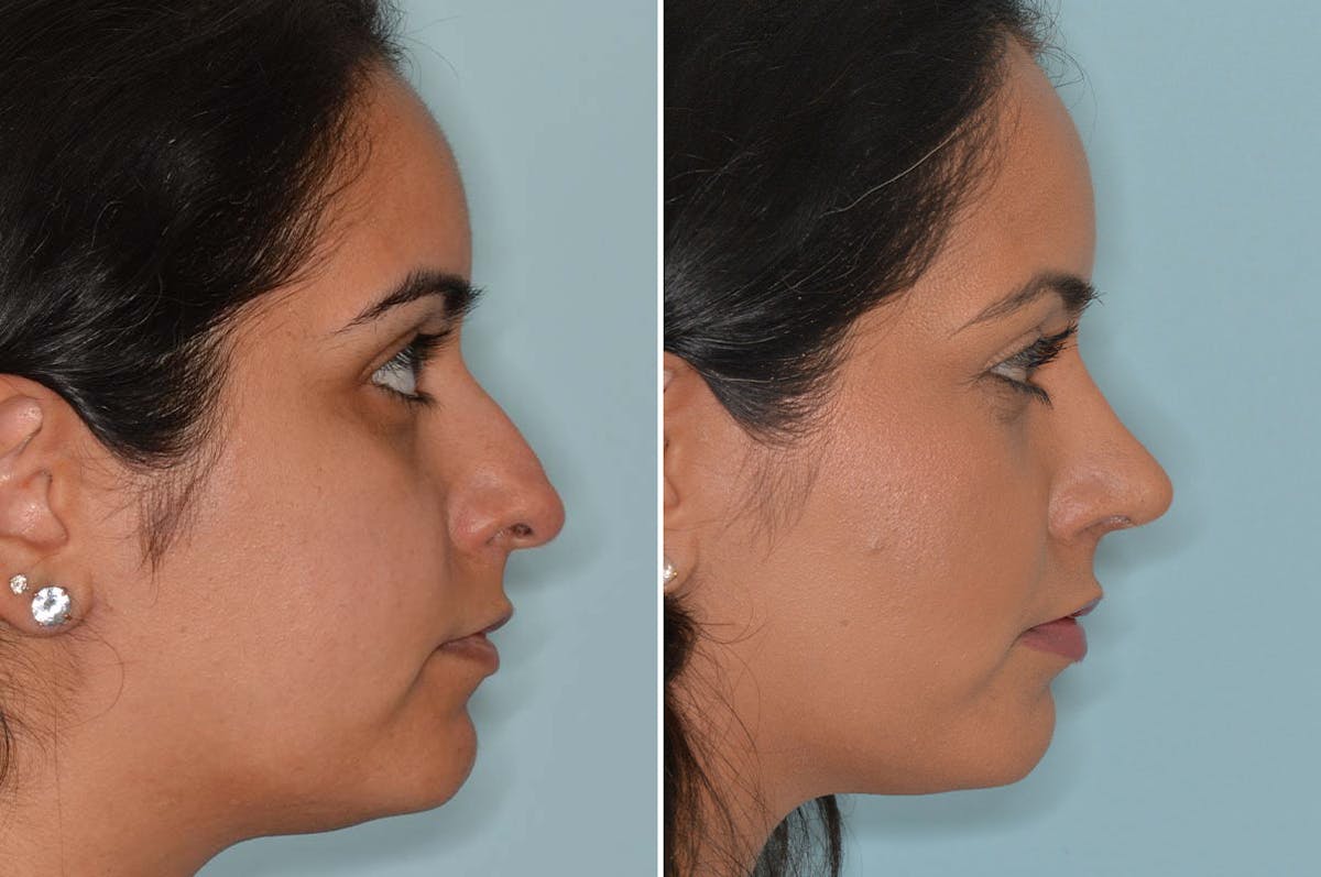 Ethnic Rhinoplasty before and after, lateral right.