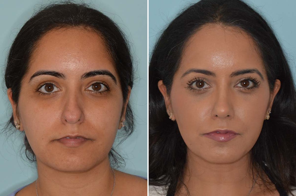Ethnic Rhinoplasty before and after, frontal.