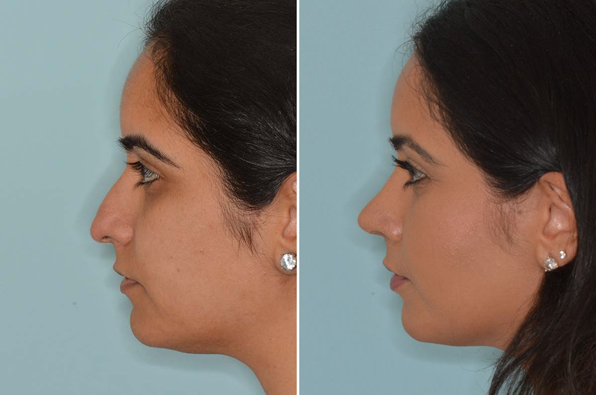 Ethnic Rhinoplasty before and after, lateral left.