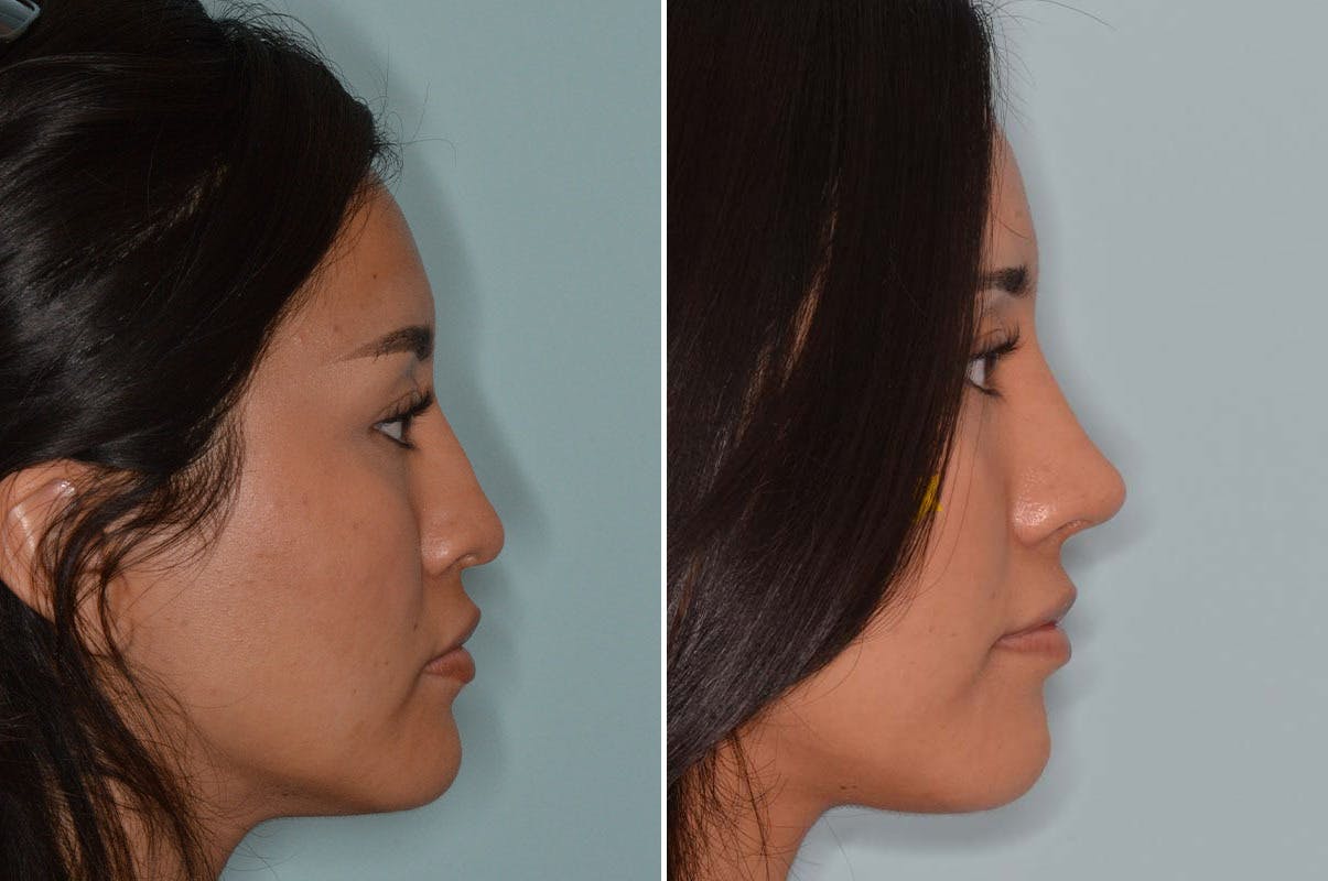 Ethnic Rhinoplasty before and after, lateral right.