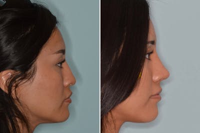 Ethnic Rhinoplasty before and after, lateral right.