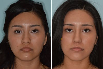Ethnic Rhinoplasty before and after, frontal.