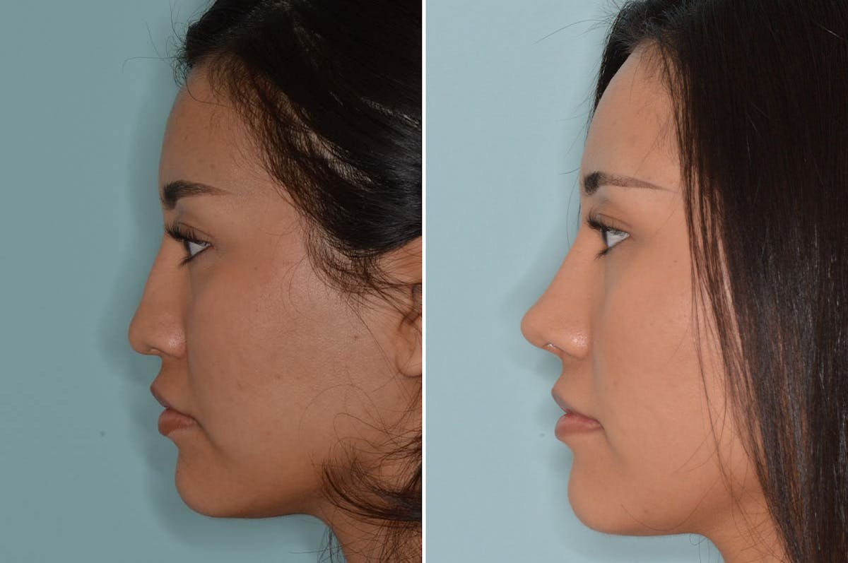 Ethnic Rhinoplasty before and after, lateral left.