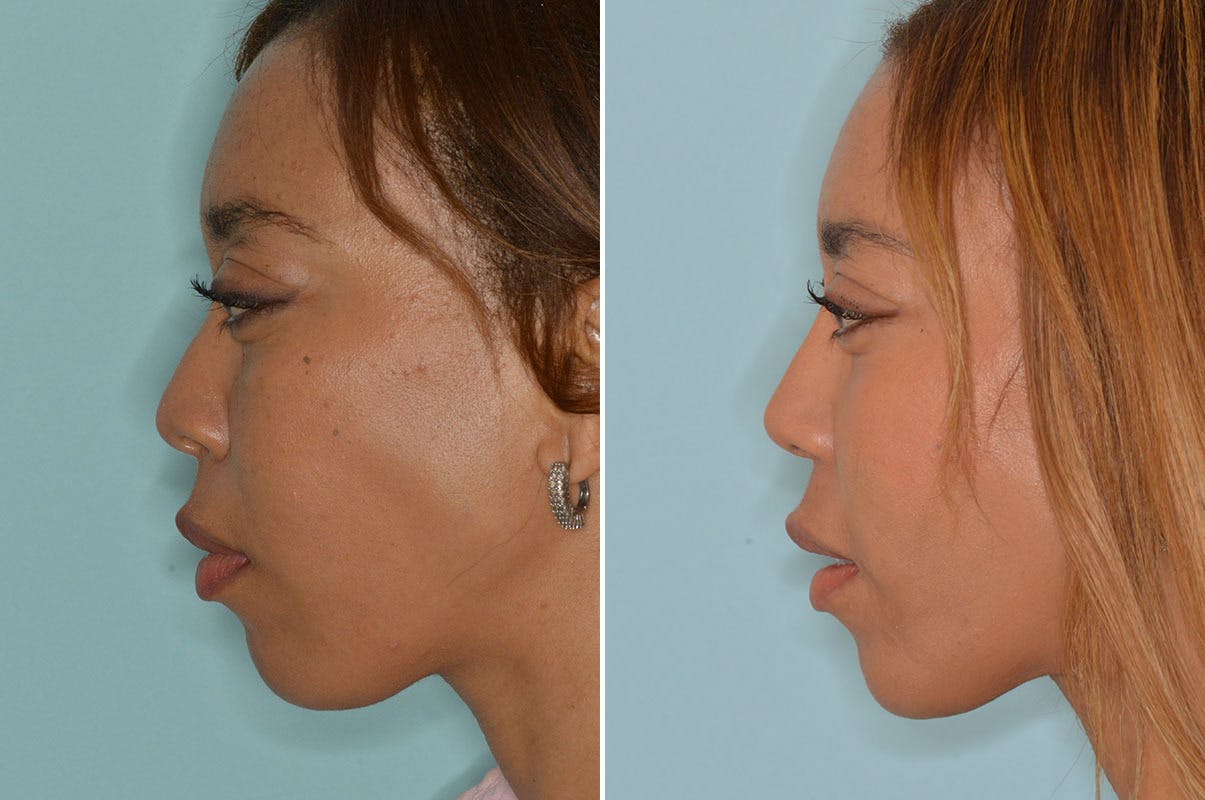 Ethnic Rhinoplasty before and after, lateral right.