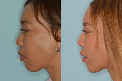 Ethnic Rhinoplasty before and after, lateral right.