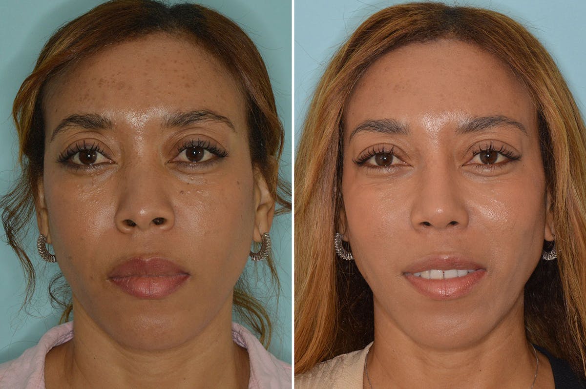 Ethnic Rhinoplasty before and after, frontal.