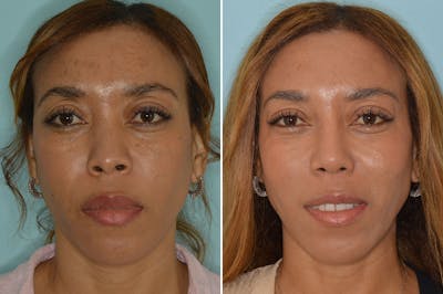 Ethnic Rhinoplasty before and after, frontal.