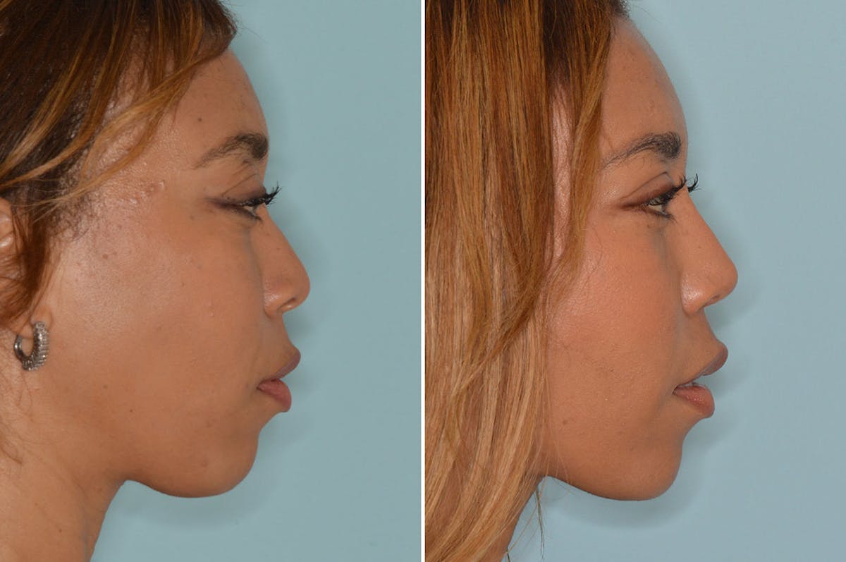 Ethnic Rhinoplasty before and after, lateral right.