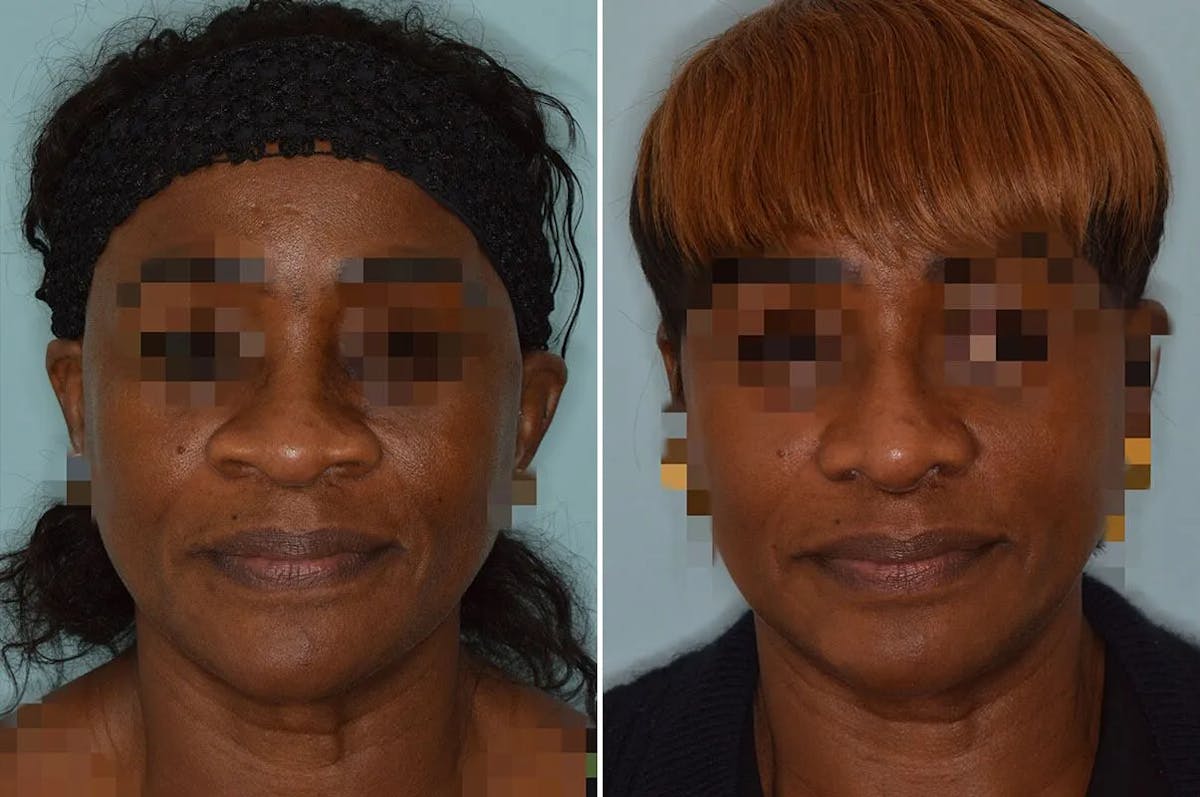 Ethnic Rhinoplasty before and after, frontal.