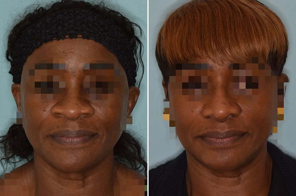 Ethnic Rhinoplasty before and after, frontal.