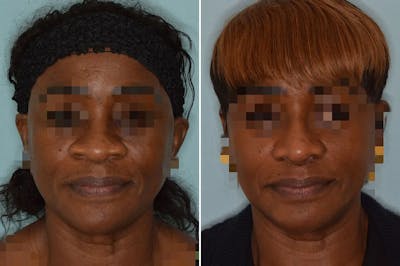Ethnic Rhinoplasty before and after, frontal.