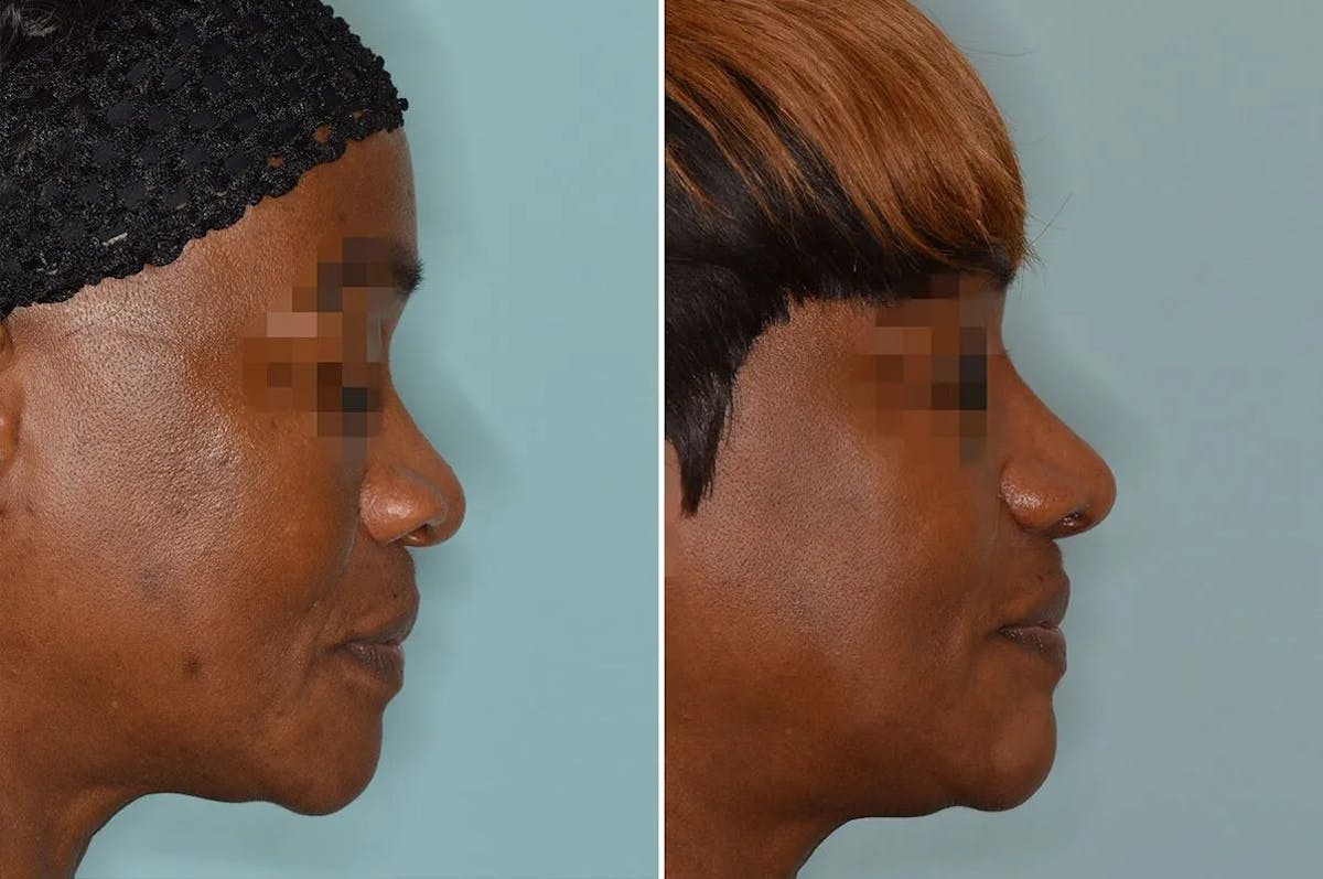 Ethnic Rhinoplasty before and after, lateral right.