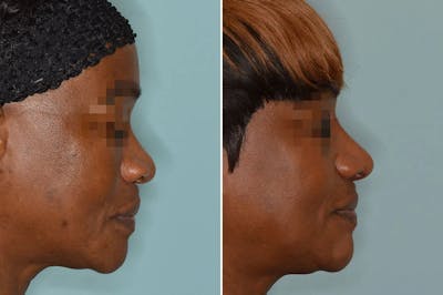 Ethnic Rhinoplasty before and after, lateral right.