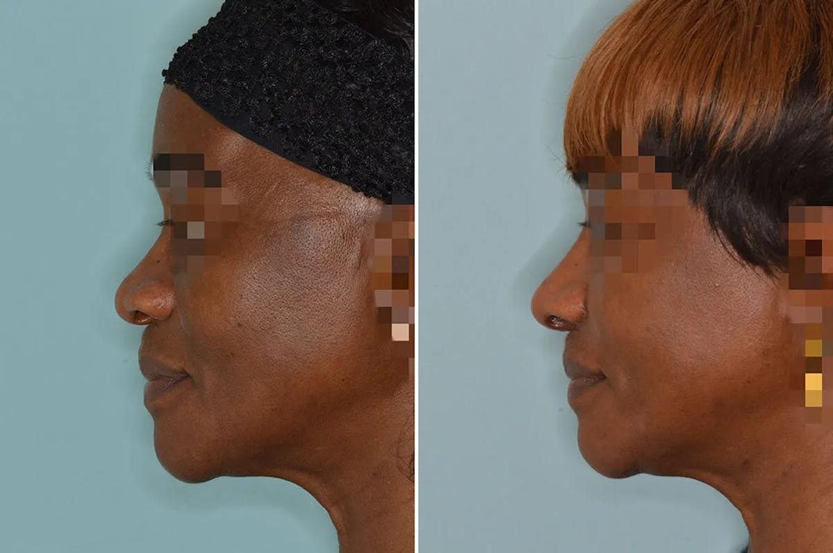 Ethnic Rhinoplasty before and after, lateral left.