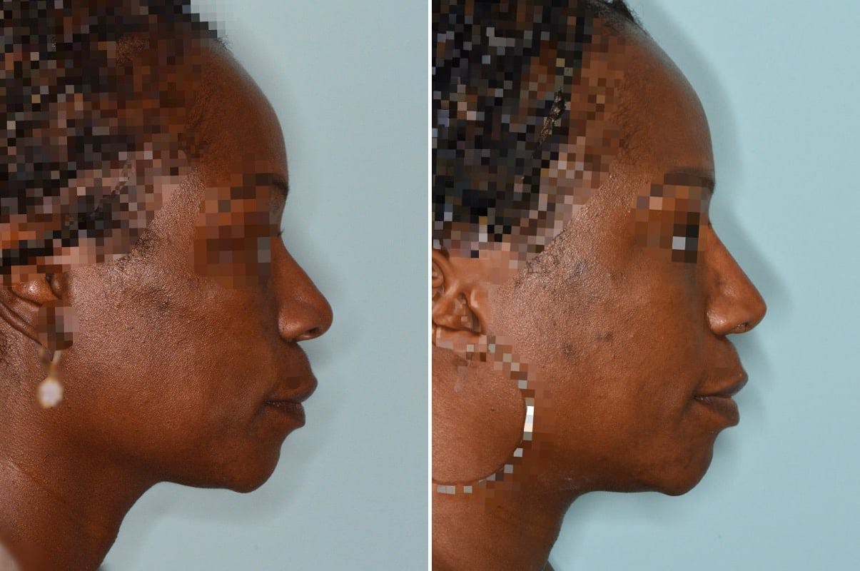 Ethnic Rhinoplasty before and after, lateral right.