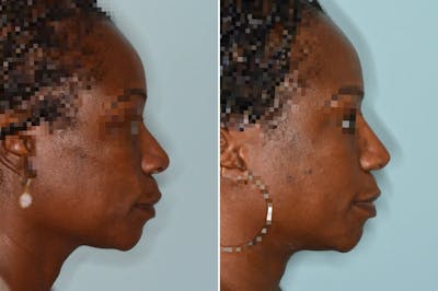 Ethnic Rhinoplasty before and after, lateral right.