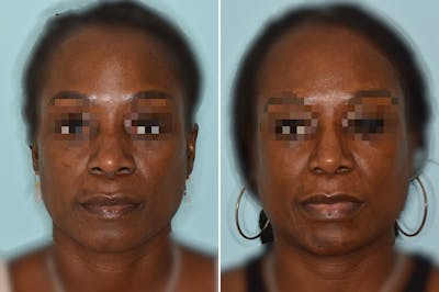 Ethnic Rhinoplasty before and after, frontal.