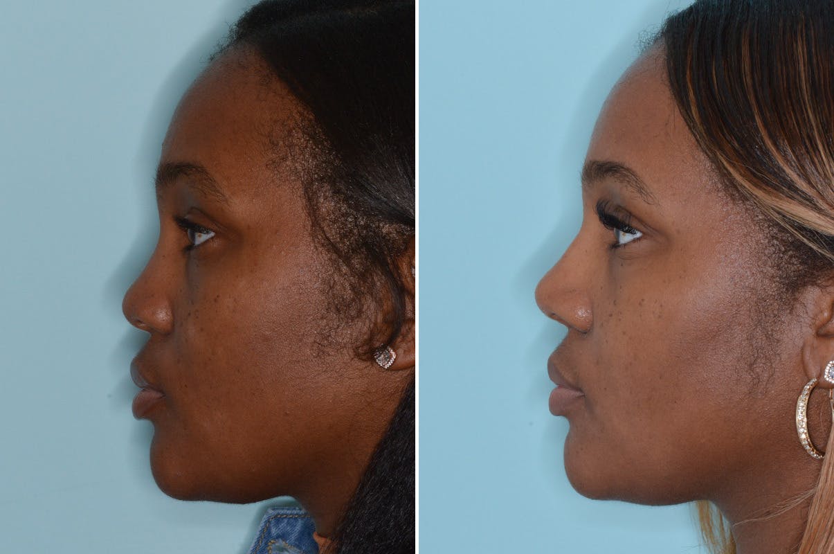 Ethnic Rhinoplasty before and after, lateral left.