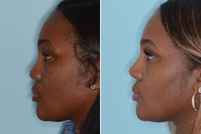 Ethnic Rhinoplasty before and after, lateral left.