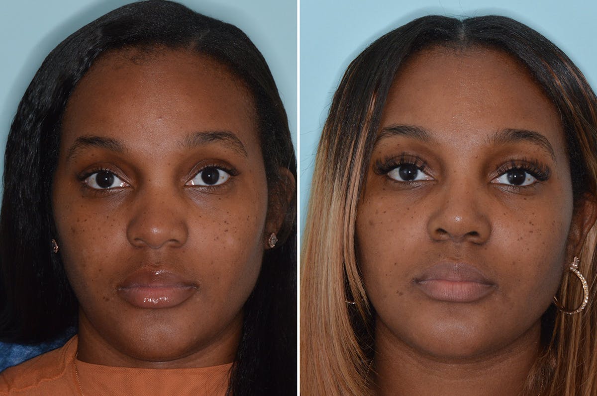 Ethnic Rhinoplasty before and after, frontal.