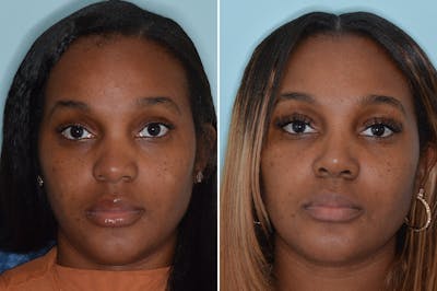 Ethnic Rhinoplasty before and after, frontal.