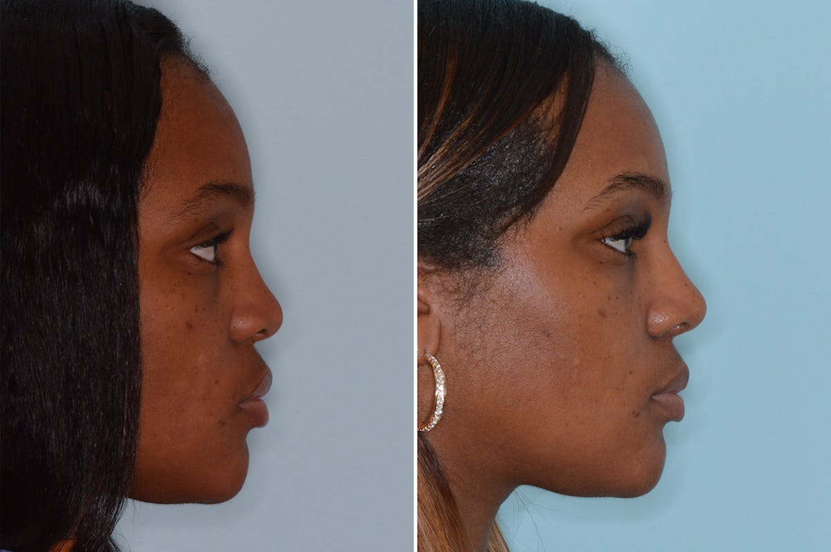 Ethnic Rhinoplasty before and after, lateral right.