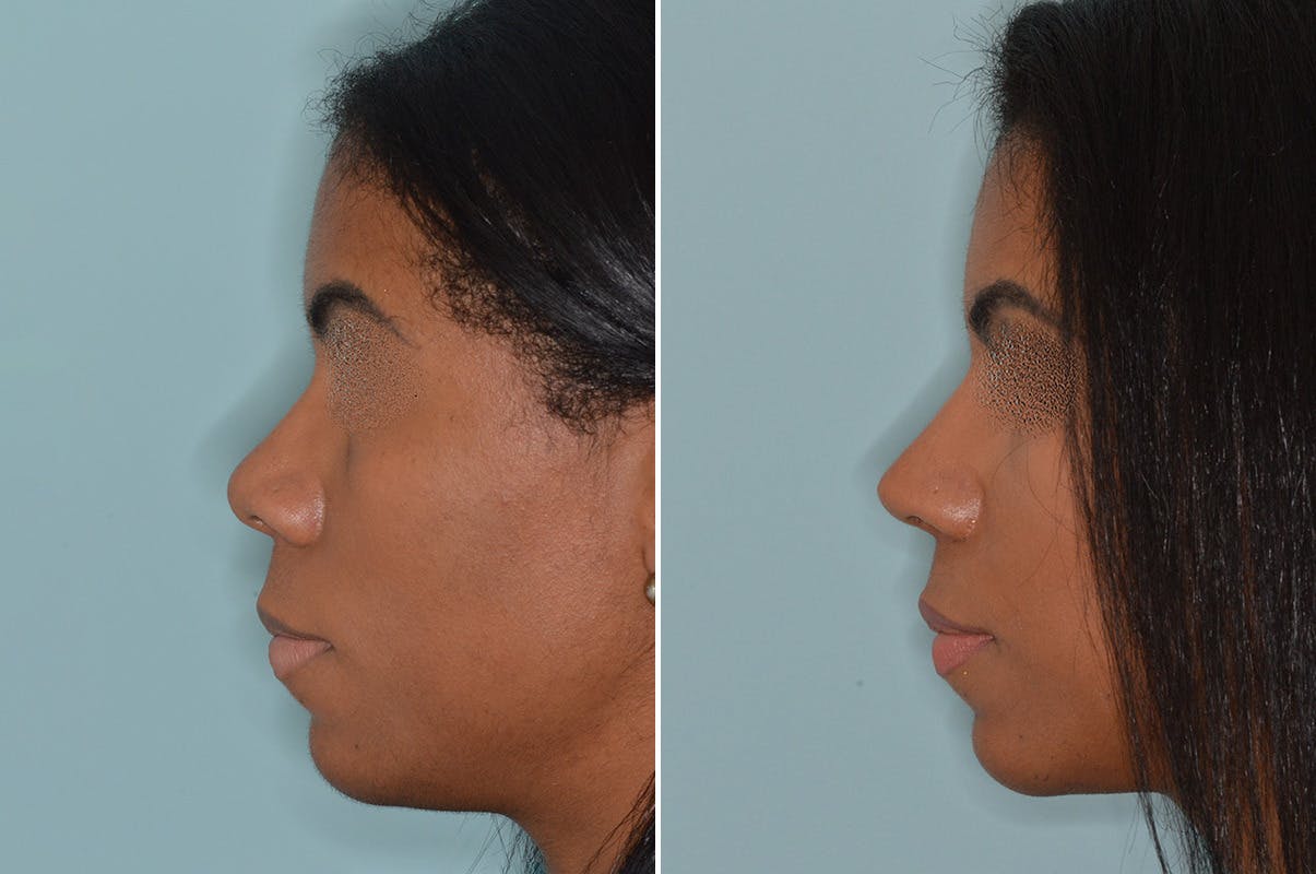 Ethnic Rhinoplasty before and after, lateral left.