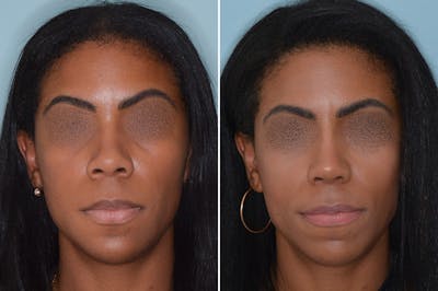 Ethnic Rhinoplasty before and after, frontal.