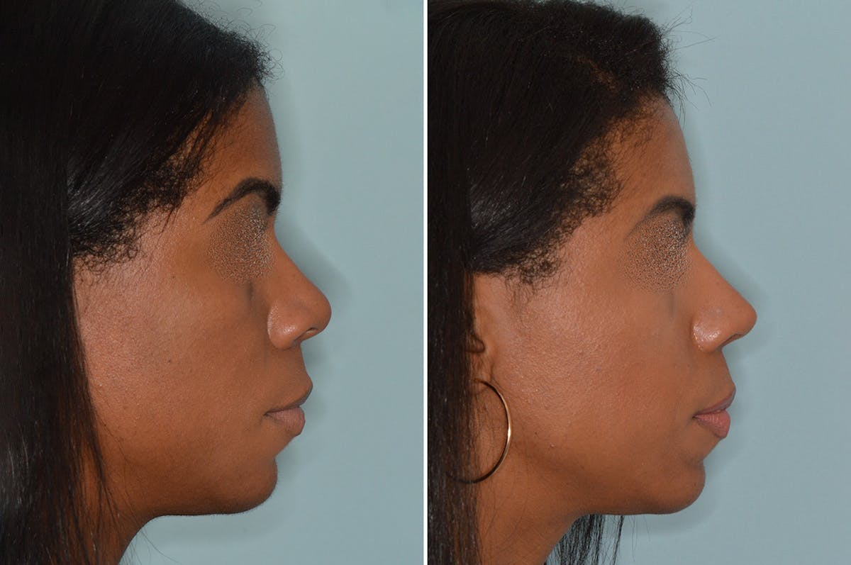 Ethnic Rhinoplasty before and after, lateral right.