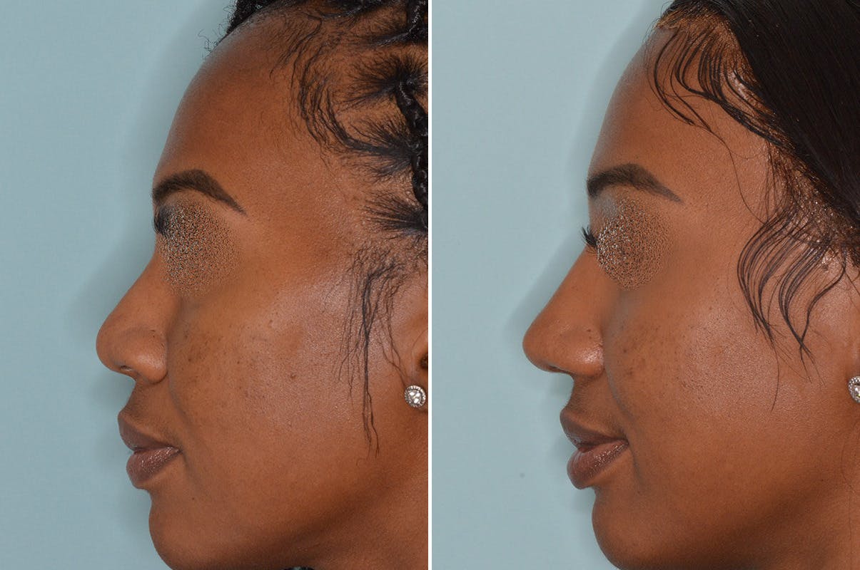 Ethnic Rhinoplasty before and after, lateral left.