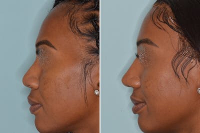 Ethnic Rhinoplasty before and after, lateral left.