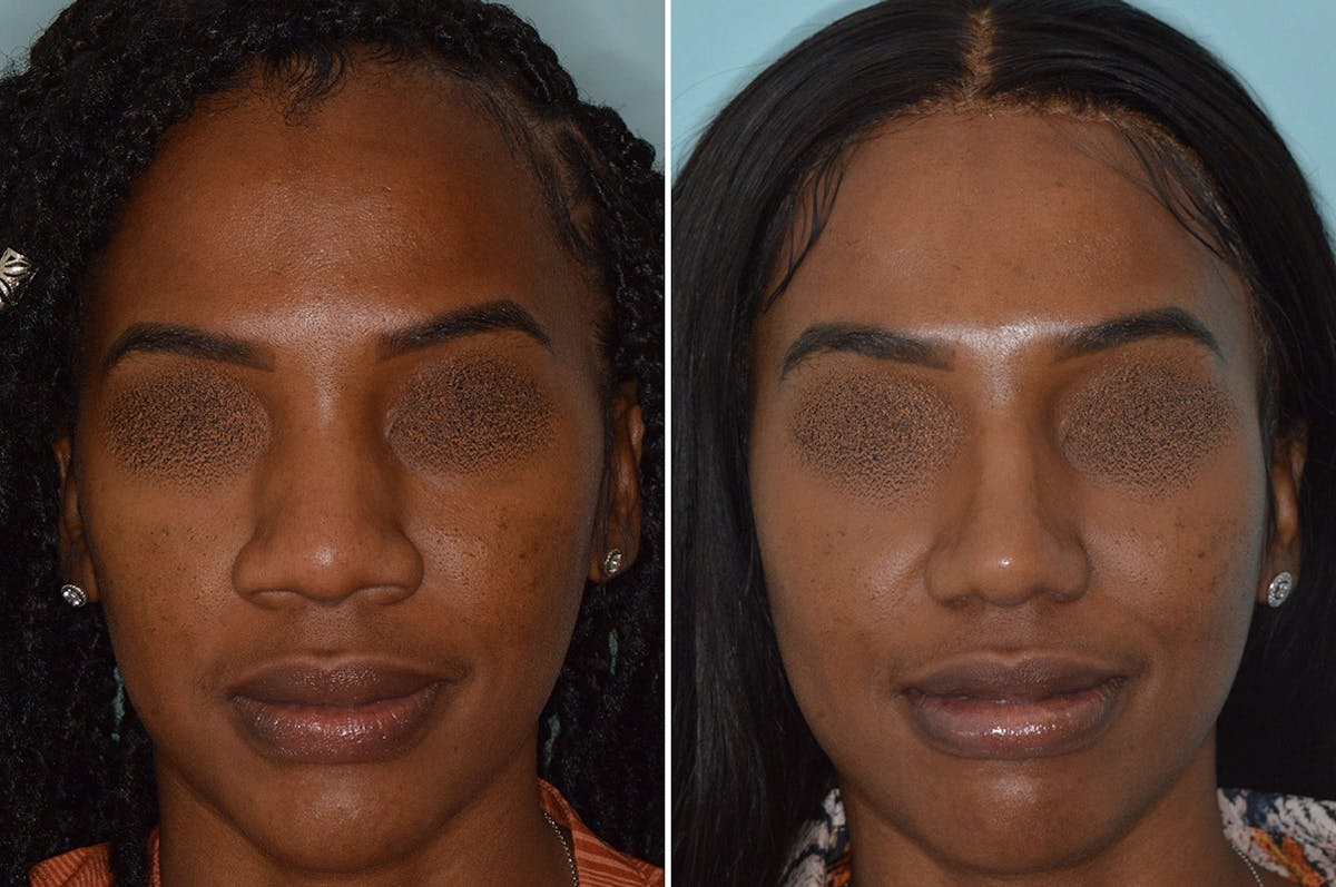 Ethnic Rhinoplasty before and after, frontal.