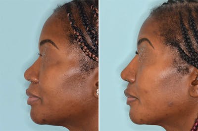 Ethnic Rhinoplasty before and after, lateral left.