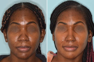 Ethnic Rhinoplasty before and after, frontal.
