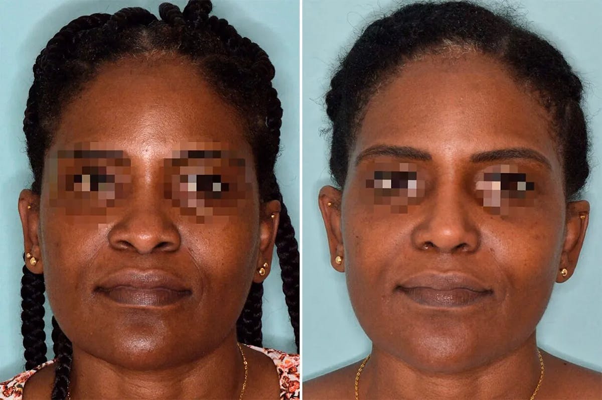 Ethnic Rhinoplasty before and after, frontal.