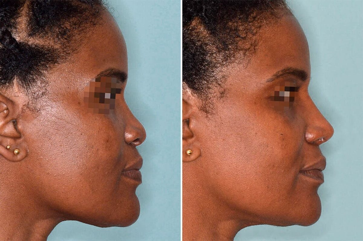 Ethnic Rhinoplasty before and after, lateral right.