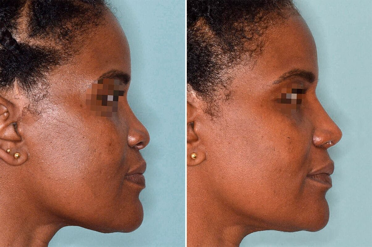 Ethnic Rhinoplasty before and after, lateral right.