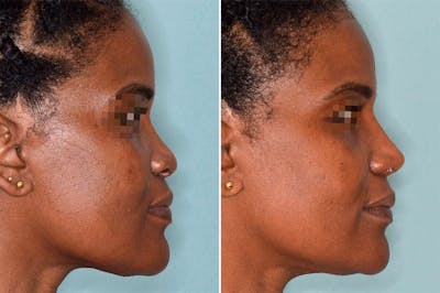 Ethnic Rhinoplasty before and after, lateral right.