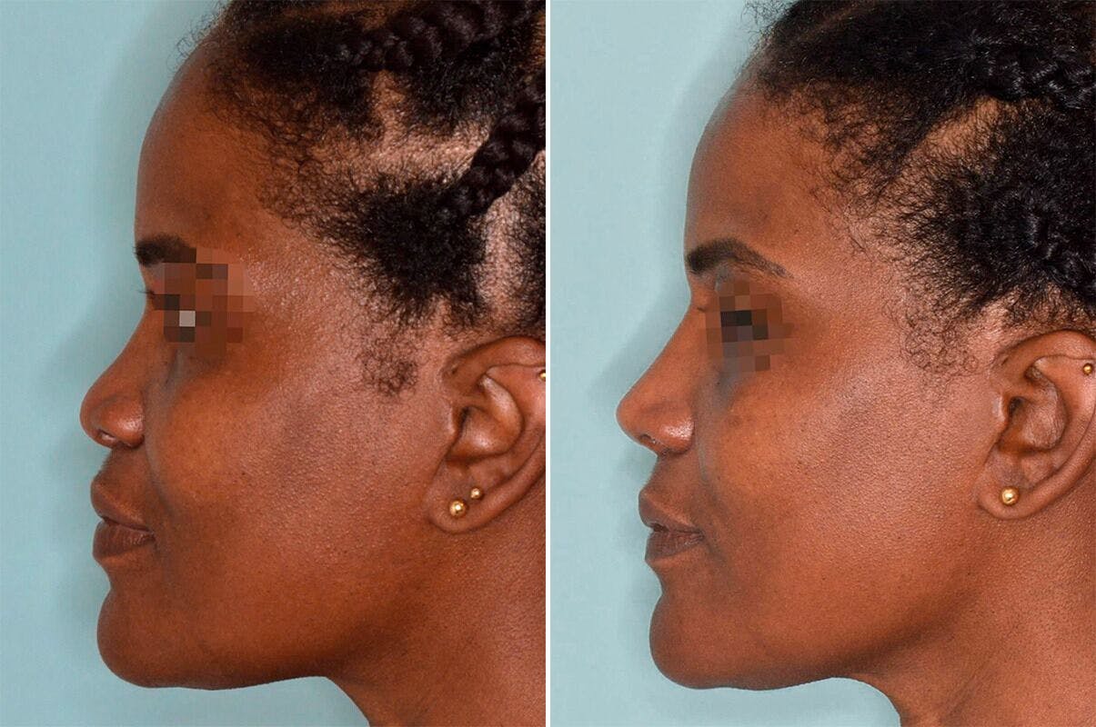 Ethnic Rhinoplasty before and after, lateral left.
