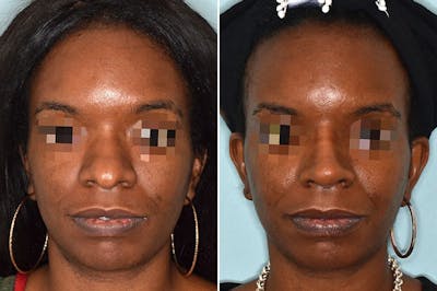 Ethnic Rhinoplasty before and after, frontal.