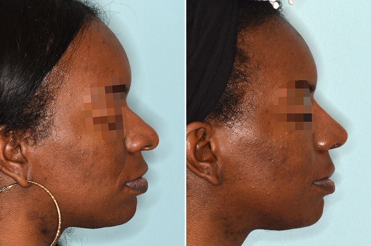 Ethnic Rhinoplasty before and after, lateral right.