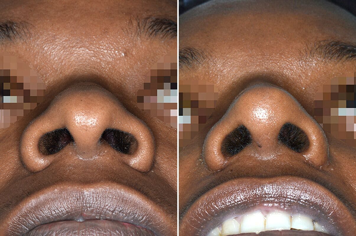 Ethnic Rhinoplasty before and after, frontal.