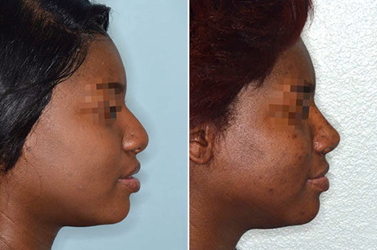 Ethnic Rhinoplasty before and after, lateral right.