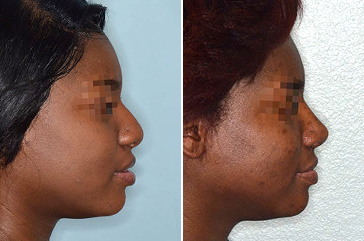 Ethnic Rhinoplasty before and after, lateral right.