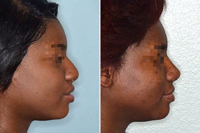 Ethnic Rhinoplasty before and after, lateral right.