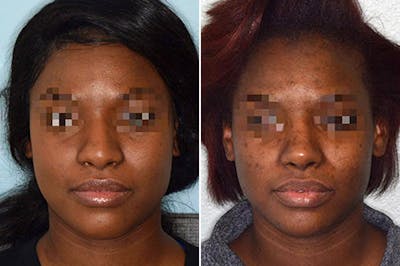 Ethnic Rhinoplasty before and after, frontal.